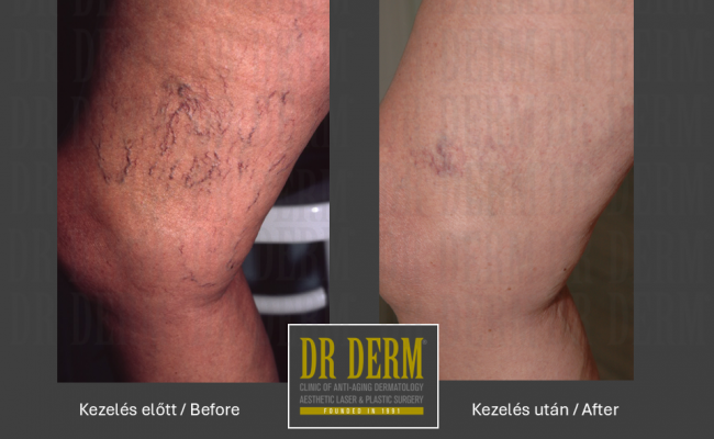 Seprűvéna kezelés_Dr Derm Budapest 1