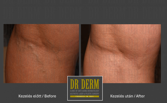 Seprűvéna kezelés_Dr Derm Budapest 10