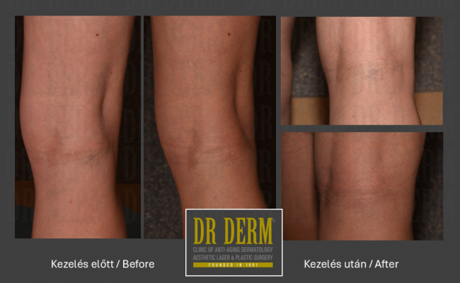 Seprűvéna kezelés_Dr Derm Budapest 11