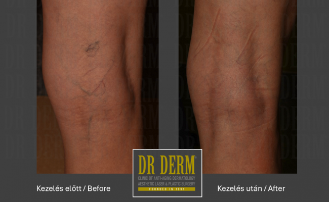 Seprűvéna kezelés_Dr Derm Budapest 12