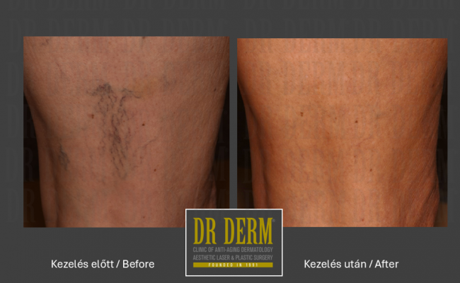 Seprűvéna kezelés_Dr Derm Budapest 13