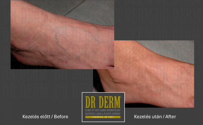 Seprűvéna kezelés_Dr Derm Budapest 2