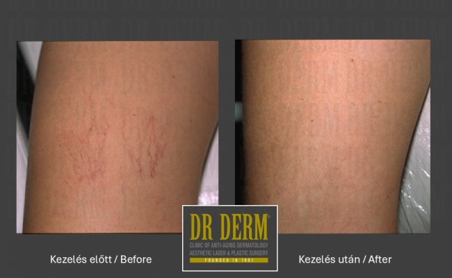 Seprűvéna kezelés_Dr Derm Budapest 3