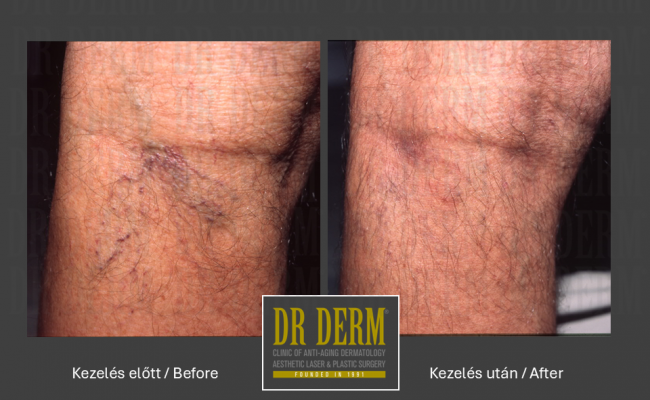 Seprűvéna kezelés_Dr Derm Budapest 4