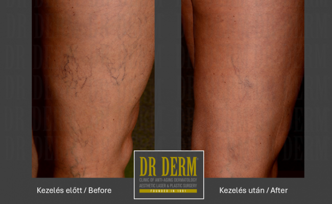 Seprűvéna kezelés_Dr Derm Budapest 5