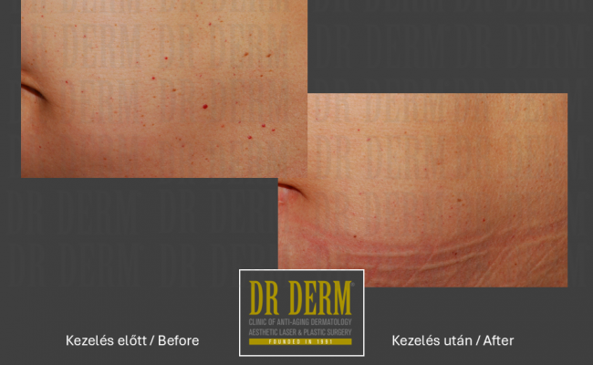Seprűvéna kezelés_Dr Derm Budapest 6