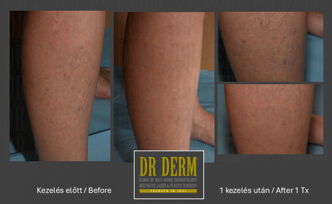 Seprűvéna kezelés_Dr Derm Budapest 7
