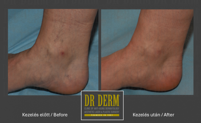 Seprűvéna kezelés_Dr Derm Budapest 8