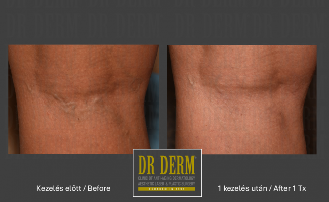 Seprűvéna kezelés_Dr Derm Budapest 9