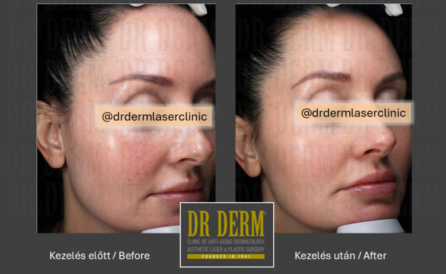 Rosacea PDL & MaxG_Dr Derm 1