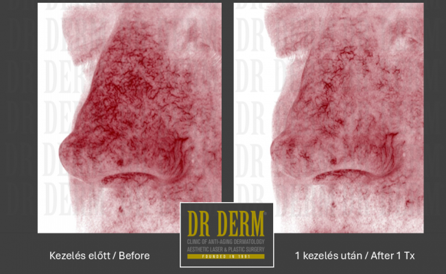 Rosacea PDL & MaxG_Dr Derm 10