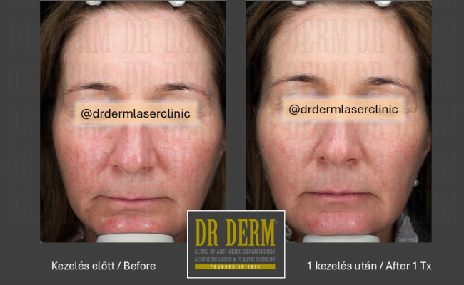Rosacea PDL & MaxG_Dr Derm 11