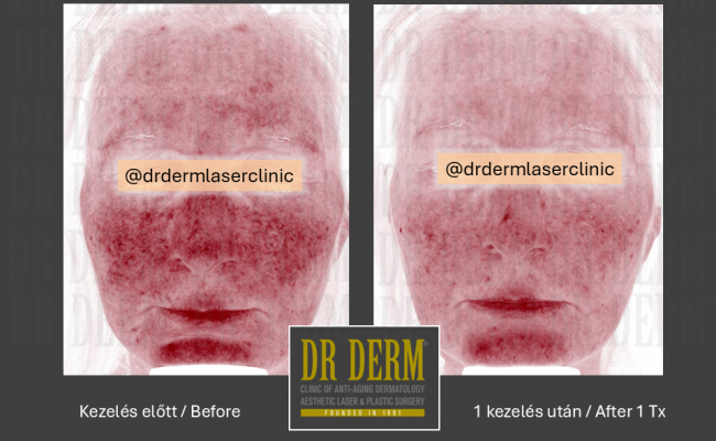 Rosacea PDL & MaxG_Dr Derm 12