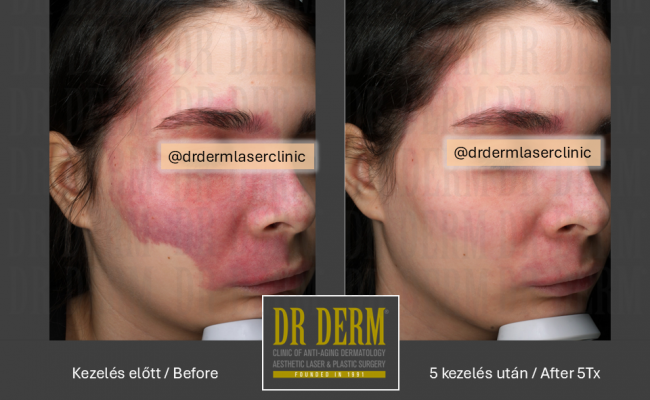 Rosacea PDL & MaxG_Dr Derm 13