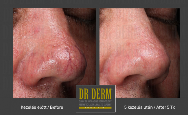 Rosacea PDL & MaxG_Dr Derm 14