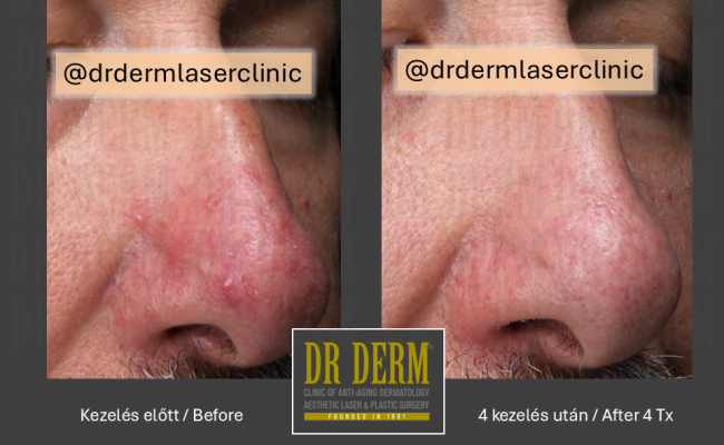 Rosacea PDL & MaxG_Dr Derm 15