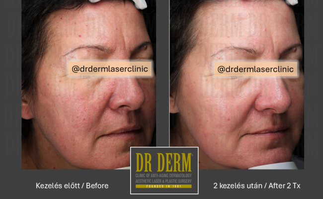 Rosacea PDL & MaxG_Dr Derm 16