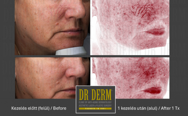 Rosacea PDL & MaxG_Dr Derm 17