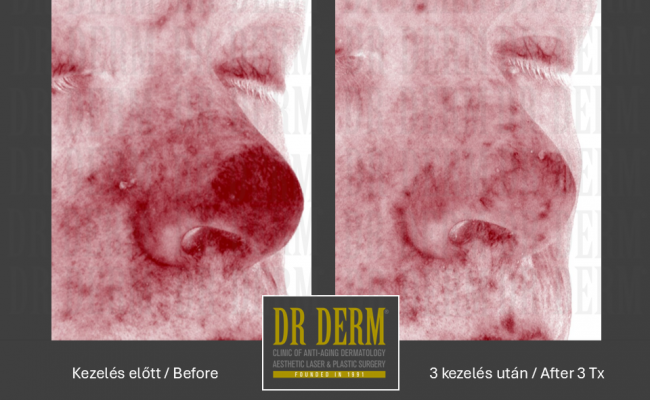 Rosacea PDL & MaxG_Dr Derm 18