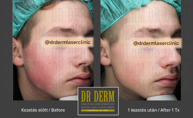 Rosacea PDL & MaxG_Dr Derm 19