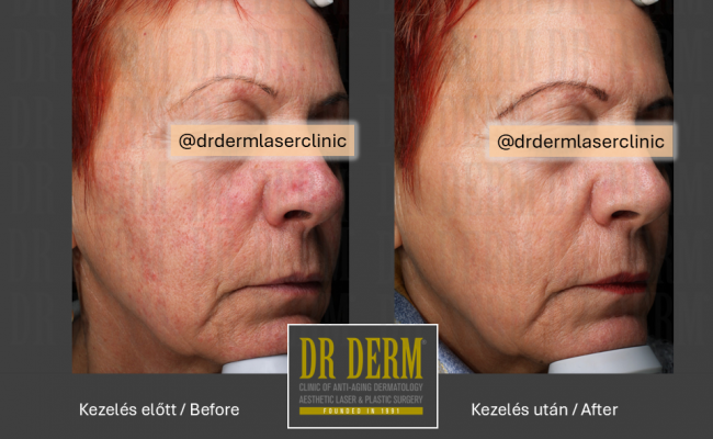 Rosacea PDL & MaxG_Dr Derm 2