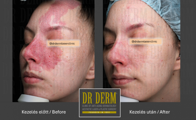 Rosacea PDL & MaxG_Dr Derm 20