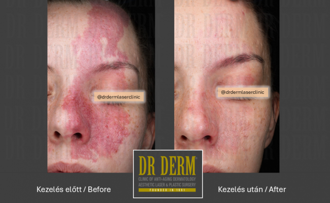 Rosacea PDL & MaxG_Dr Derm 21