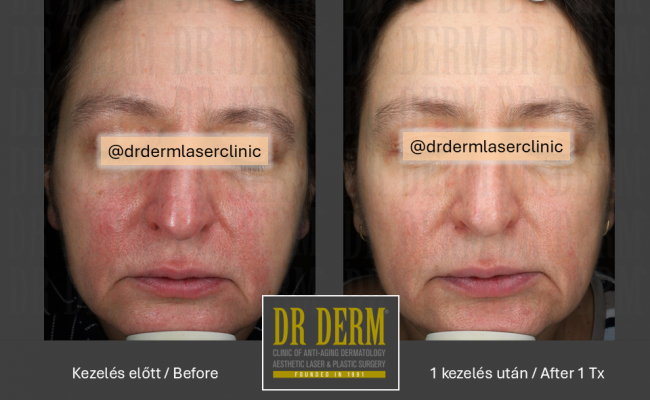 Rosacea PDL & MaxG_Dr Derm 22