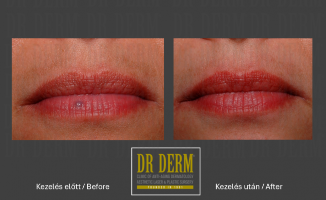 Rosacea PDL & MaxG_Dr Derm 23