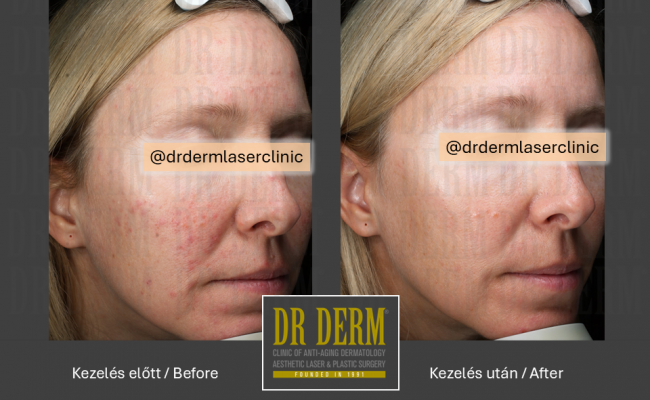 Rosacea PDL & MaxG_Dr Derm 3