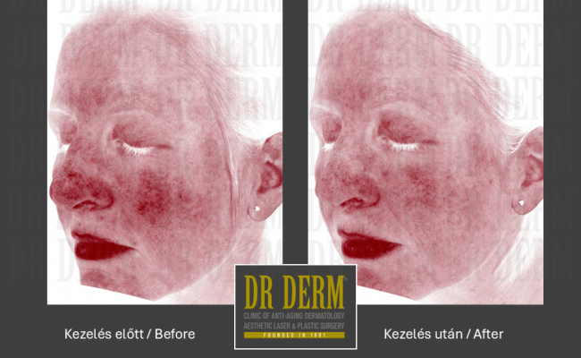 Rosacea PDL & MaxG_Dr Derm 4