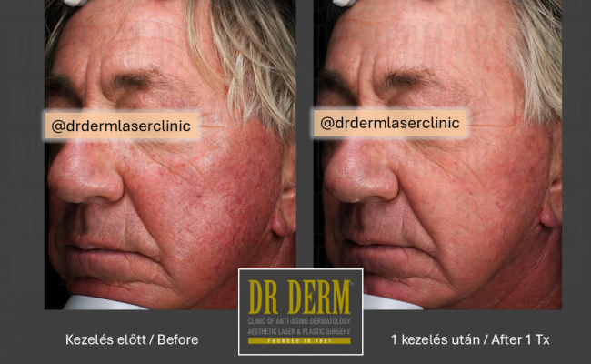 Rosacea PDL & MaxG_Dr Derm 5