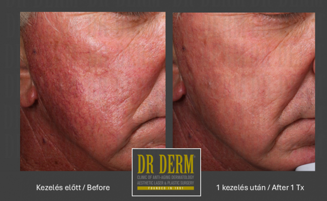 Rosacea PDL & MaxG_Dr Derm 6