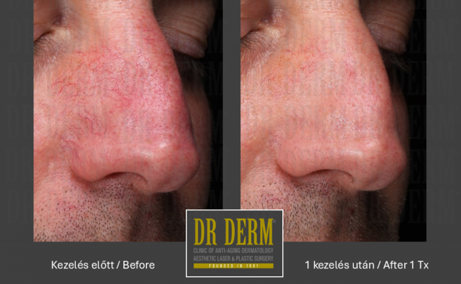 Rosacea PDL & MaxG_Dr Derm 7