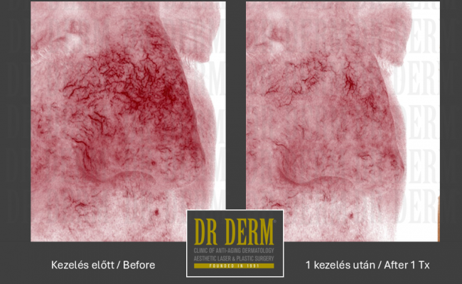 Rosacea PDL & MaxG_Dr Derm 8