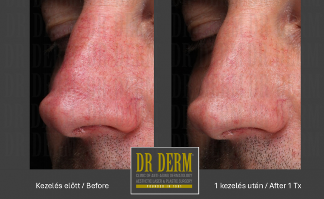 Rosacea PDL & MaxG_Dr Derm 9