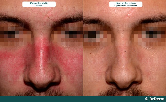 rosacea102