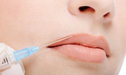 Hyaluronsavas ajakfeltöltés, szájfeltöltés