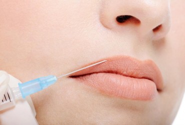 Lip filling