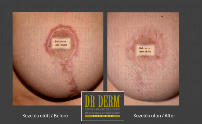 Hegkezelés_Dr Derm Budapest 1