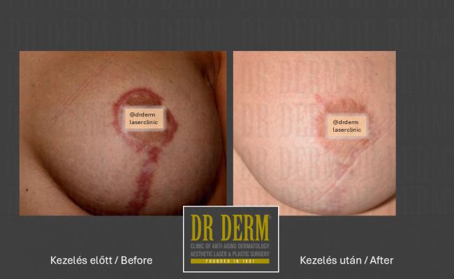 Hegkezelés_Dr Derm Budapest 2