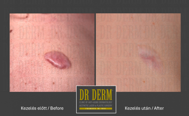 Hegkezelés_Dr Derm Budapest 3
