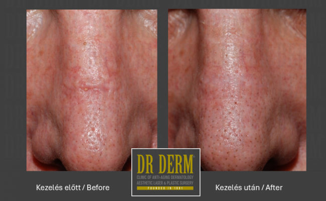Hegkezelés_Dr Derm Budapest 4