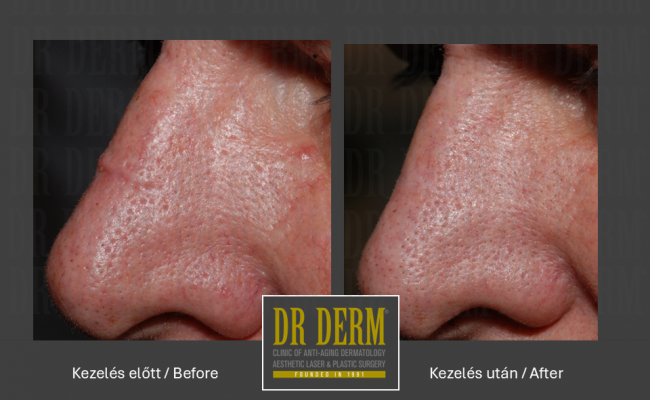 Hegkezelés_Dr Derm Budapest 5