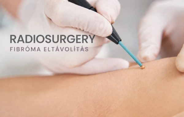 Fibroma eltávolítás rádióhullámmal