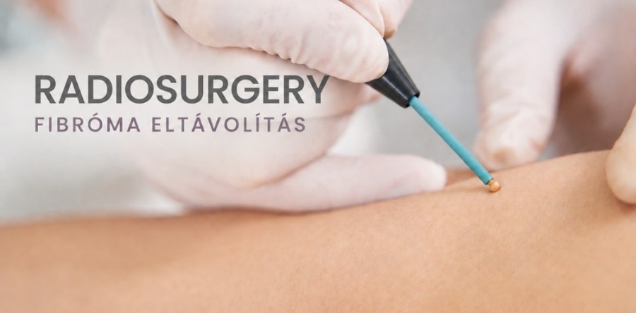Fibroma eltávolítás rádióhullámmal