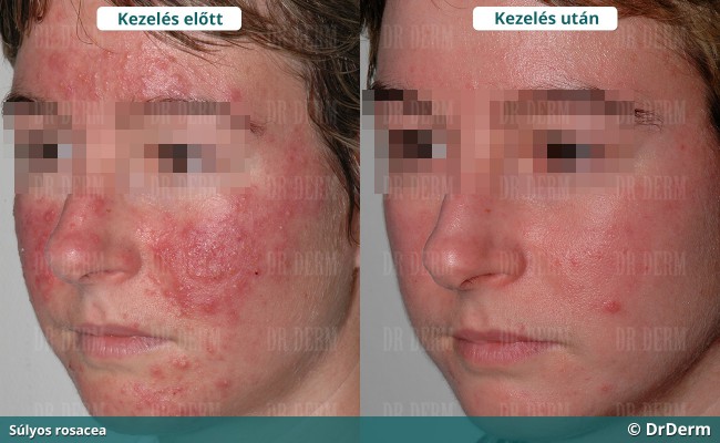 rosacea_10