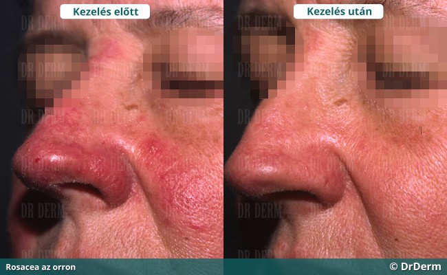 rosacea_6