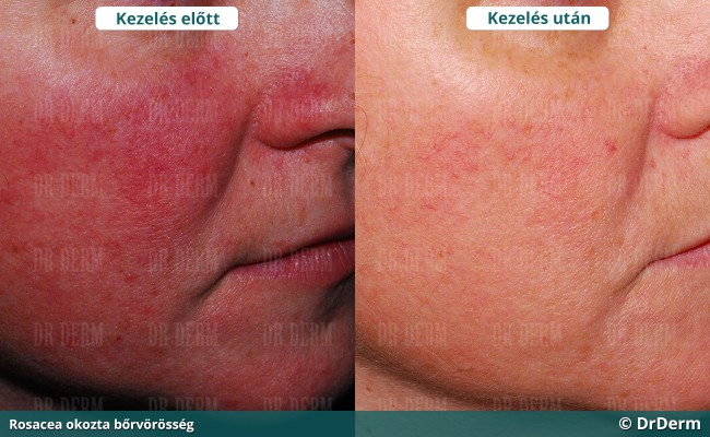 rosacea_9