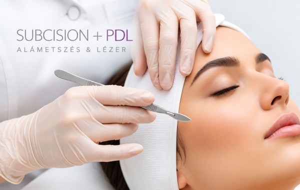 Alámetszés (subcision + PDL) aknés hegre